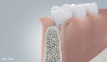 Ablauf Implantatversorgung 1 Ablauf Implantatversorgung 1