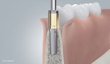 Ablauf Implantatversorgung 2 Ablauf Implantatversorgung 2