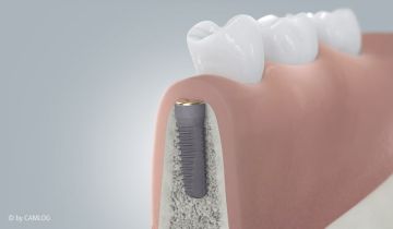 Ablauf Implantatversorgung 3 Ablauf Implantatversorgung 3