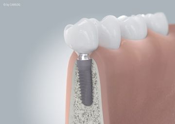 Ablauf Implantatversorgung 4 Ablauf Implantatversorgung 4